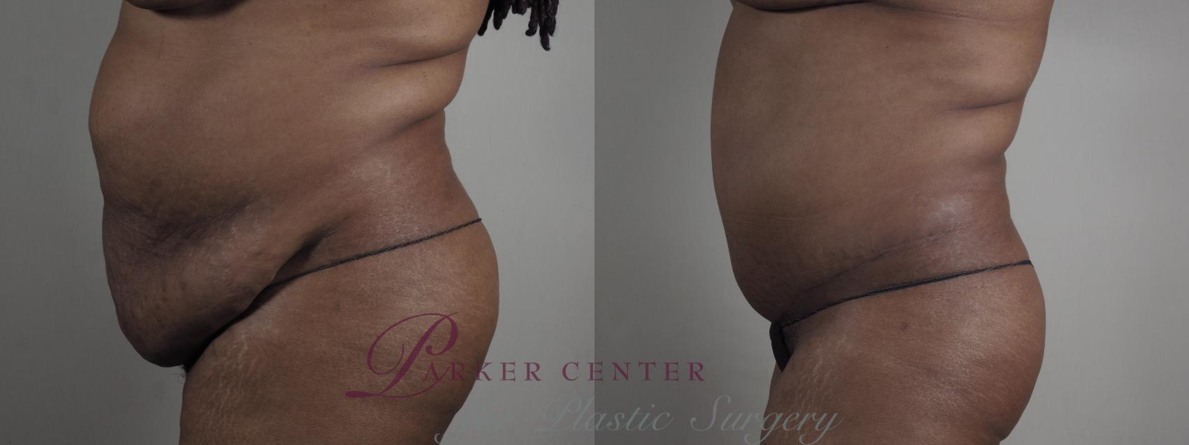 Breast Reduction Case 980 Before & After Right view Body  | Paramus, NJ | Parker Center for Plastic Surgery