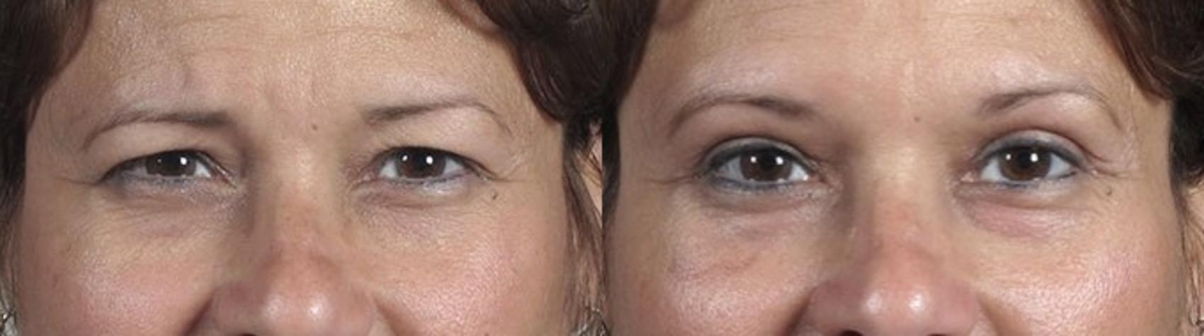 Brow Lift Case 107 Before & After View #1 | Paramus, NJ | Parker Center for Plastic Surgery