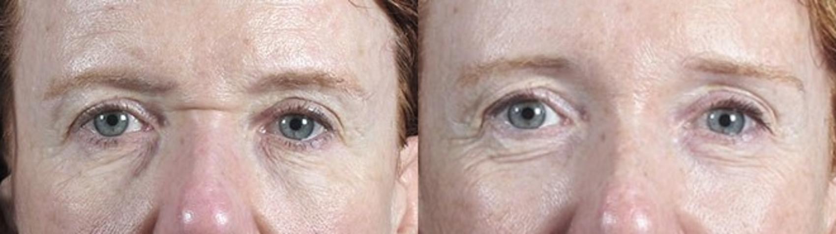 Brow Lift Case 115 Before & After View #1 | Paramus, NJ | Parker Center for Plastic Surgery