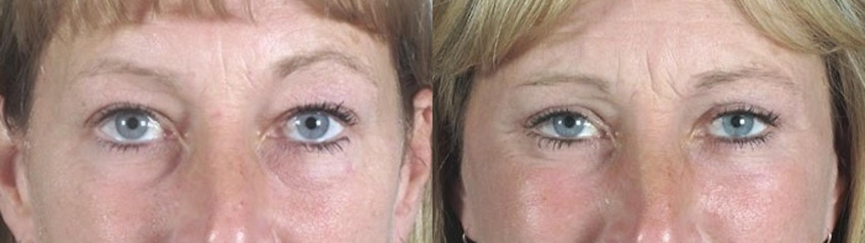 Brow Lift Case 1176 Before & After View 1  | Paramus, New Jersey | Parker Center for Plastic Surgery