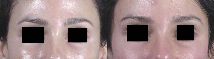 Brow Lift Case 1476 Before & After Front | Paramus, New Jersey | Parker Center for Plastic Surgery