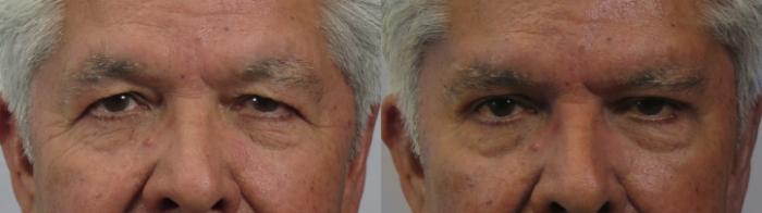 Brow Lift Case 1609 Before & After front 2 | Paramus, New Jersey | Parker Center for Plastic Surgery