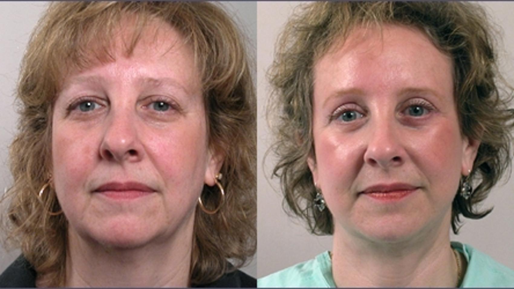 Facelift Case 2 Before & After View #1 | Paramus, NJ | Parker Center for Plastic Surgery