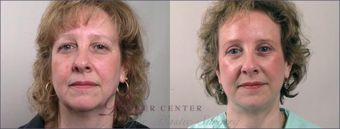 Facelift Case 2 Before & After View #1 | Paramus, NJ | Parker Center for Plastic Surgery