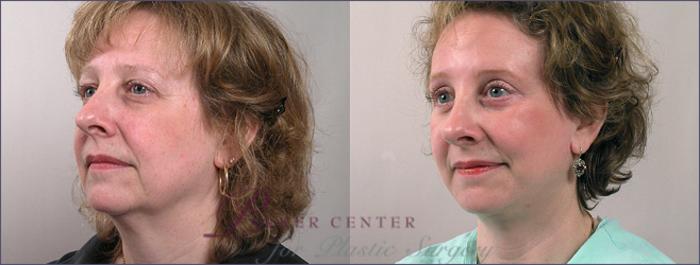 Facelift Case 2 Before & After View #2 | Paramus, NJ | Parker Center for Plastic Surgery