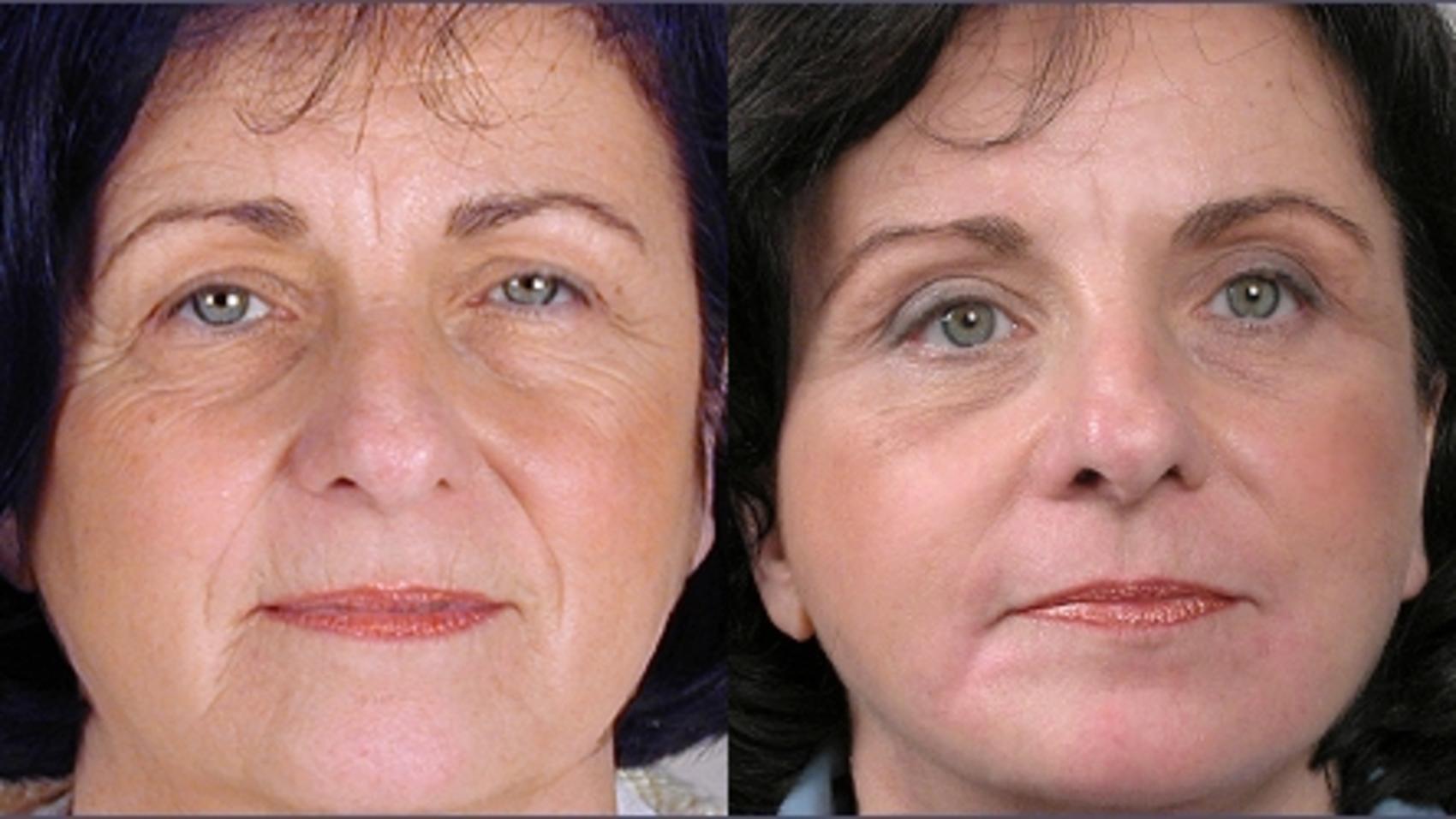 Eyelid Lift Case 3 Before & After View #1 | Paramus, NJ | Parker Center for Plastic Surgery