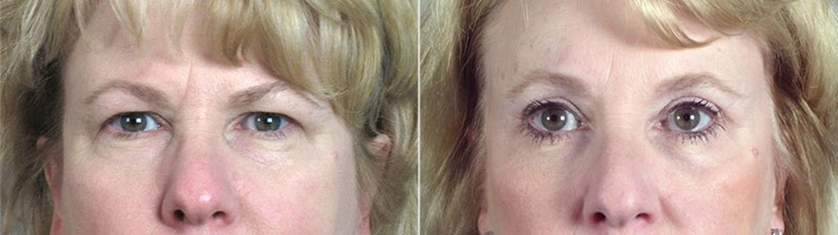 Brow Lift Case 66 Before & After View #1 | Paramus, NJ | Parker Center for Plastic Surgery