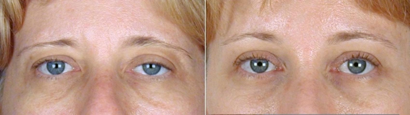 Brow Lift Case 872 Before & After View #4 | Paramus, NJ | Parker Center for Plastic Surgery