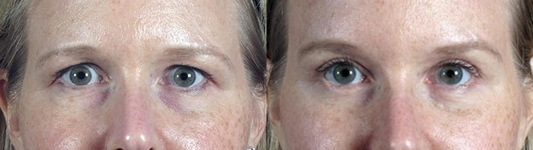 Brow Lift Case 98 Before & After View #1 | Paramus, New Jersey | Parker Center for Plastic Surgery