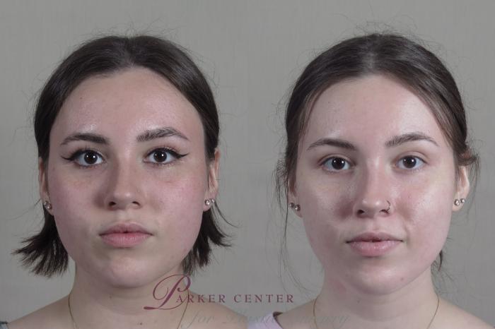 Buccal Fat Excision Case 1280 Before & After Front | Paramus, NJ | Parker Center for Plastic Surgery