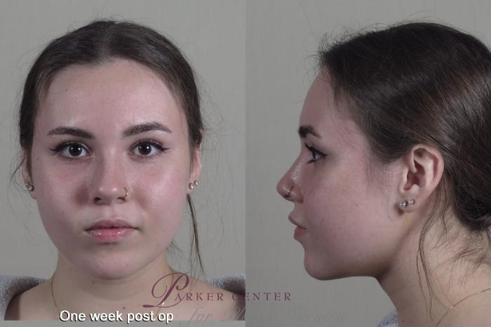Buccal Fat Excision Case 1356 Before & After 1 week  | Paramus, New Jersey | Parker Center for Plastic Surgery