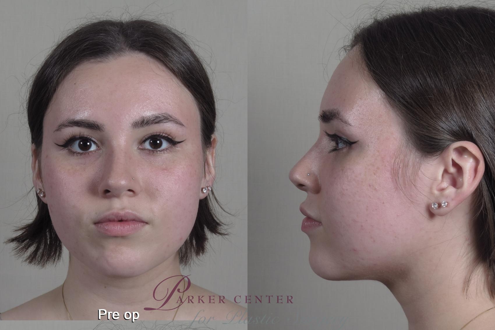 Buccal Fat Excision Case 1356 Before & After pre op  | Paramus, New Jersey | Parker Center for Plastic Surgery