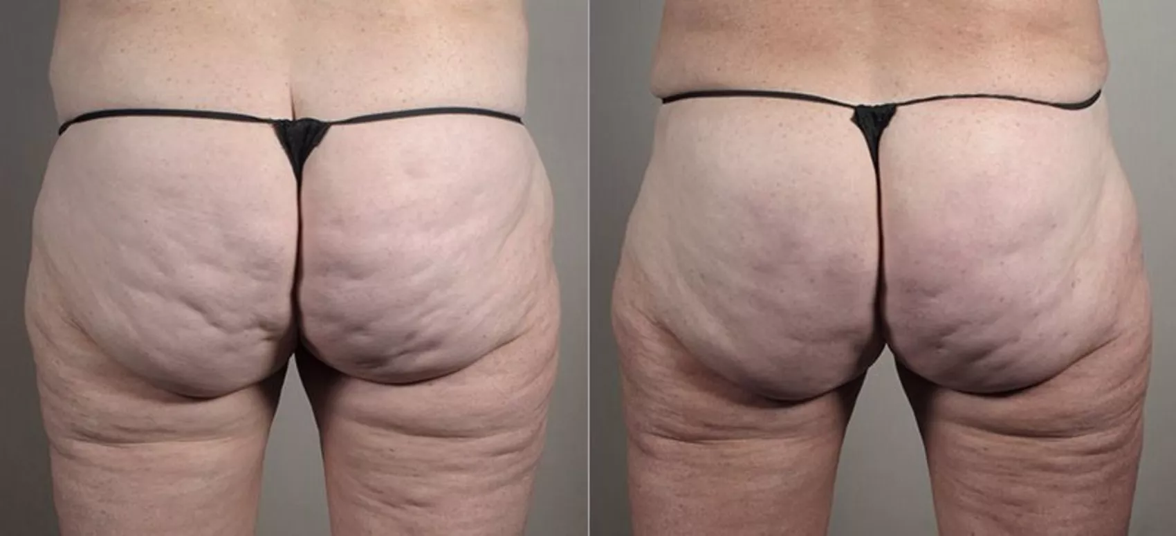 Cellfina Cellulite Treatment: Cost, Reviews, Treatment