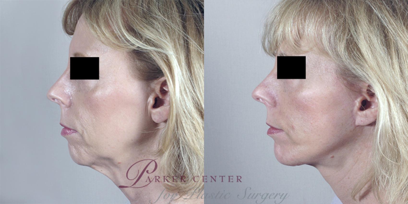 Facelift Case 10 Before & After View #1 | Paramus, NJ | Parker Center for Plastic Surgery