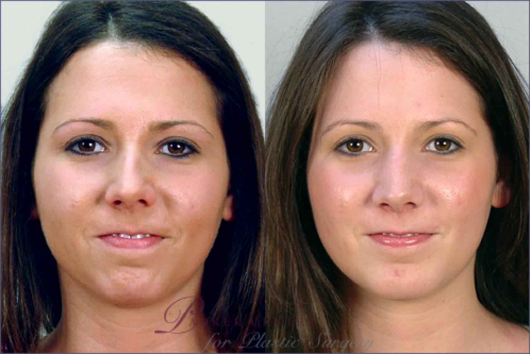 Cheek/Chin Implants Case 120 Before & After View #1 | Paramus, NJ | Parker Center for Plastic Surgery