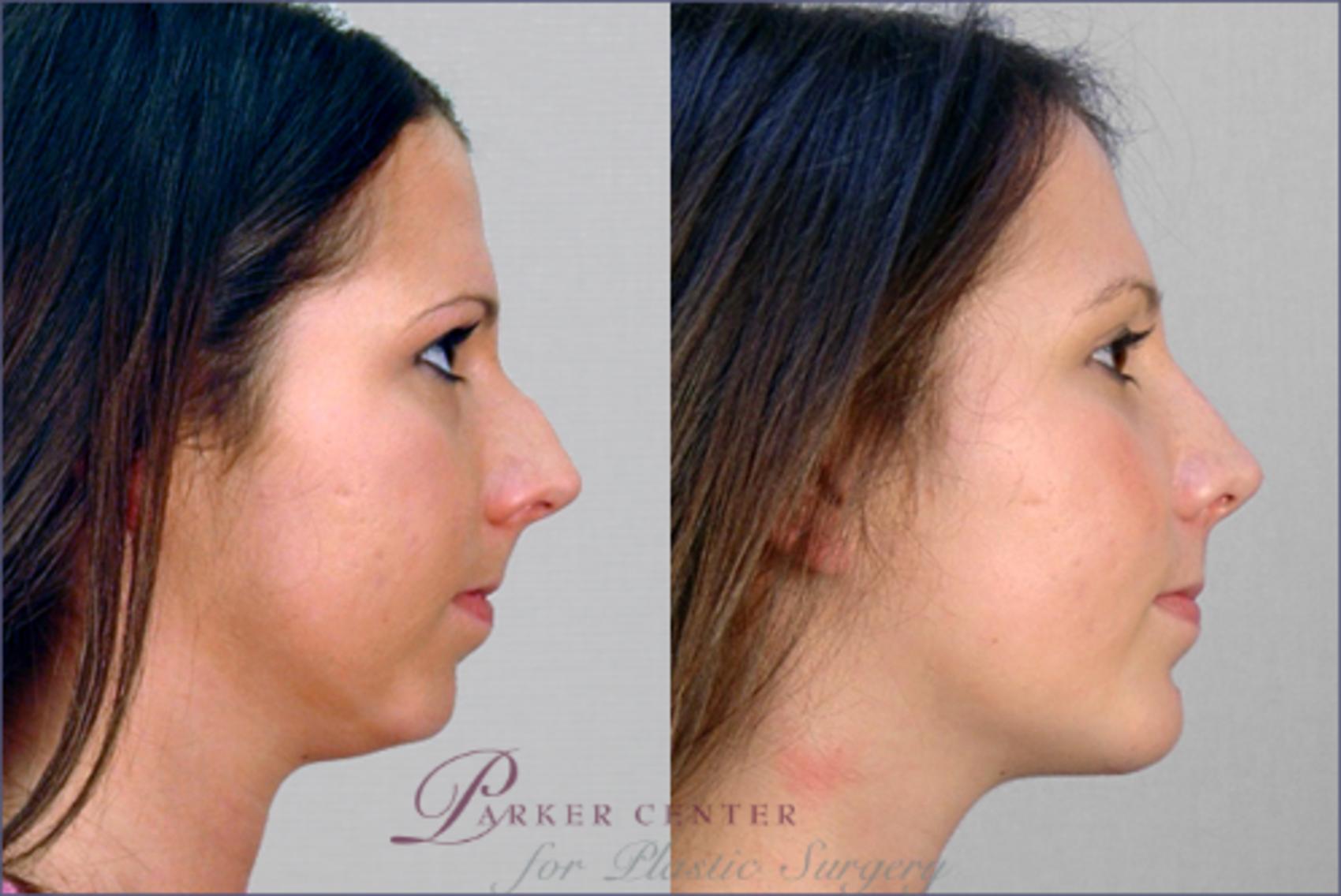 Cheek/Chin Implants Case 120 Before & After View #2 | Paramus, NJ | Parker Center for Plastic Surgery