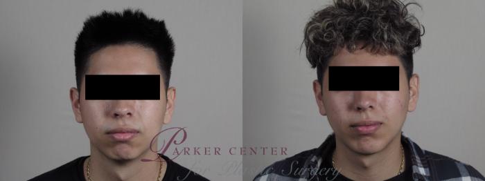 Cheek/Chin Implants Case 1207 Before & After View #2 | Paramus, NJ | Parker Center for Plastic Surgery