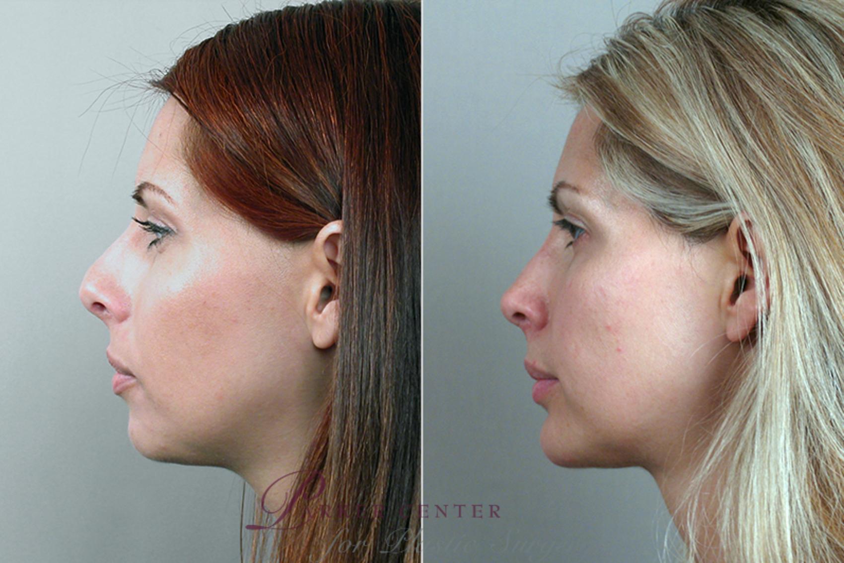 Cheek/Chin Implants Case 125 Before & After View #2 | Paramus, NJ | Parker Center for Plastic Surgery