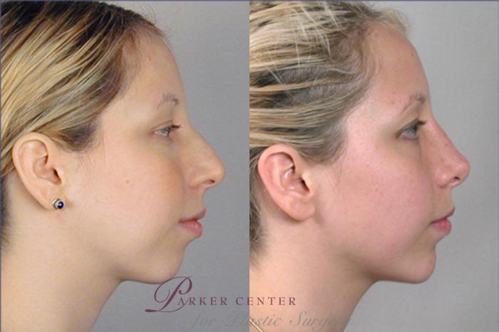 Cheek/Chin Implants Case 1378 Before & After Left Side | Paramus, New Jersey | Parker Center for Plastic Surgery