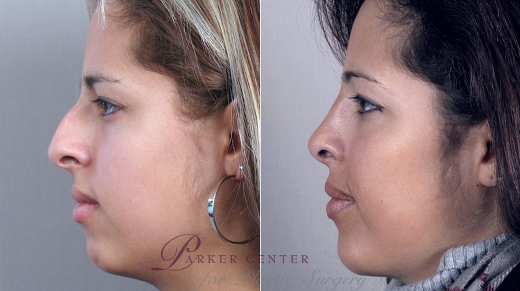 Cheek/Chin Implants Case 155 Before & After View #2 | Paramus, New Jersey | Parker Center for Plastic Surgery