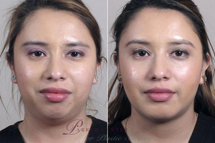 Cheek/Chin Implants Case 228 Before & After View #1 | Paramus, NJ | Parker Center for Plastic Surgery