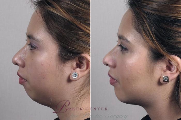 Cheek/Chin Implants Case 228 Before & After View #2 | Paramus, New Jersey | Parker Center for Plastic Surgery