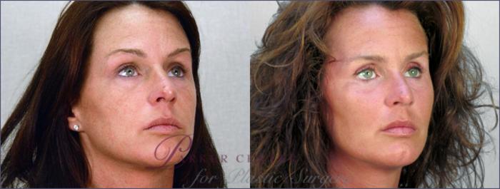 Cheek/Chin Implants Case 253 Before & After View #2 | Paramus, NJ | Parker Center for Plastic Surgery