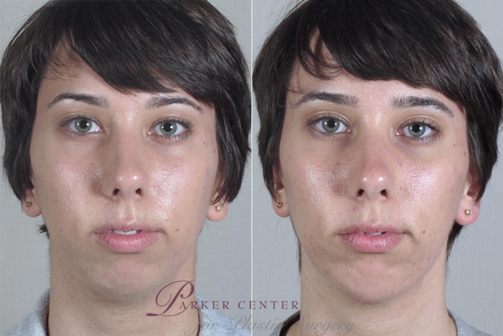 Cheek/Chin Implants Case 254 Before & After View #1 | Paramus, NJ | Parker Center for Plastic Surgery