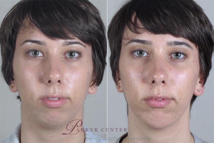 Cheek/Chin Implants Case 254 Before & After View #1 | Paramus, NJ | Parker Center for Plastic Surgery