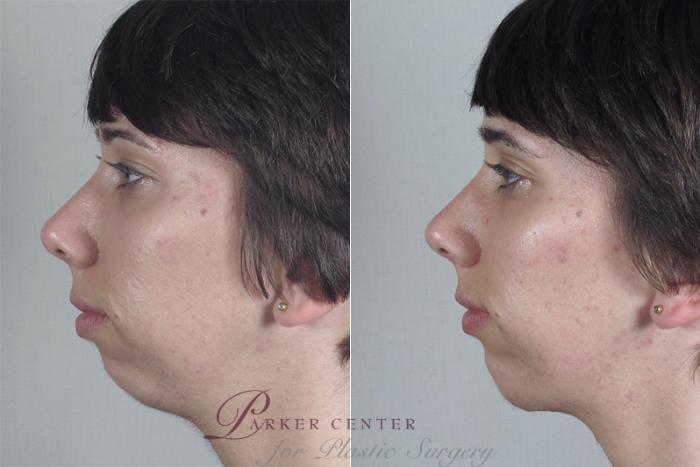 Cheek/Chin Implants Case 254 Before & After View #2 | Paramus, New Jersey | Parker Center for Plastic Surgery