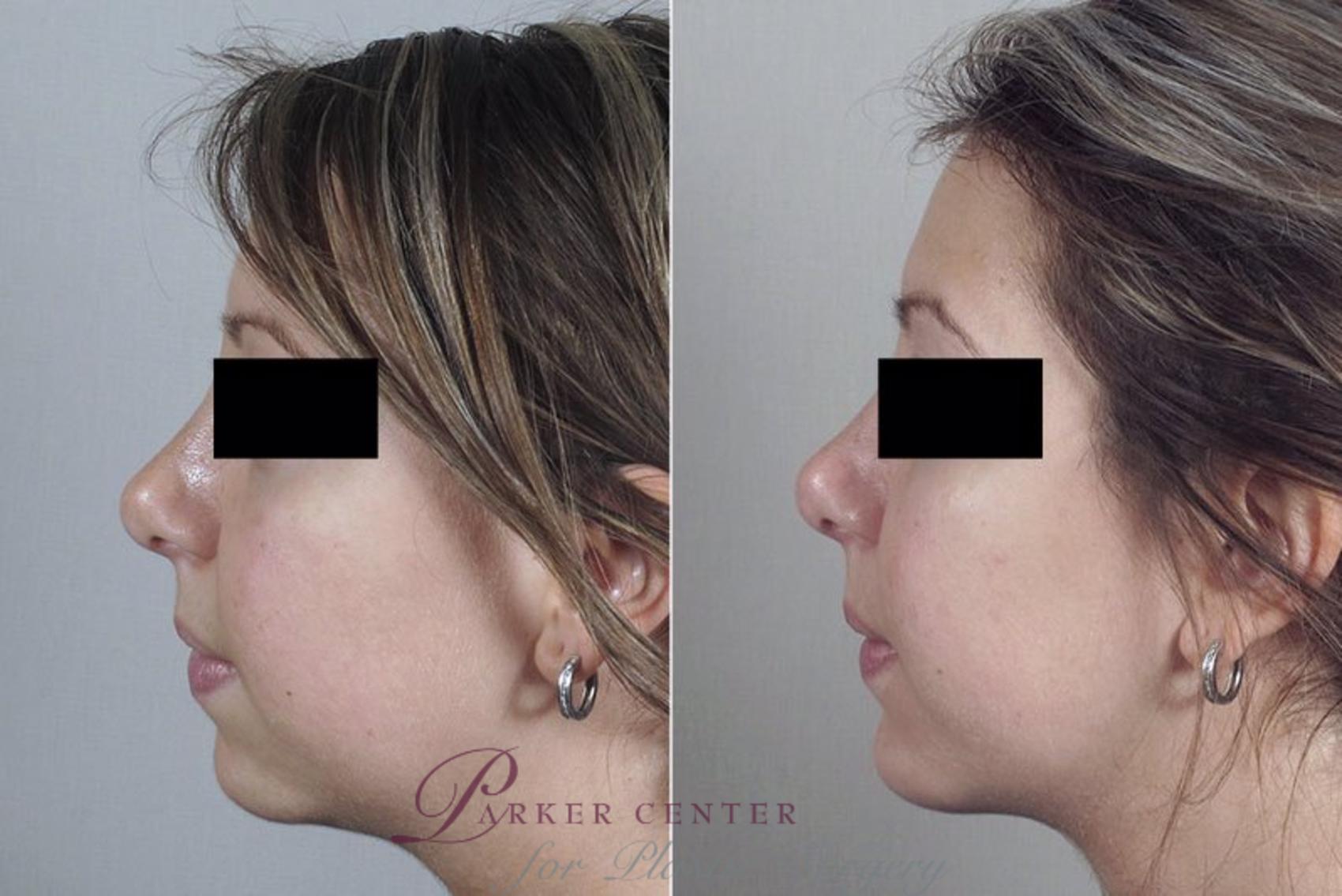 Cheek/Chin Implants Case 255 Before & After View #2 | Paramus, NJ | Parker Center for Plastic Surgery