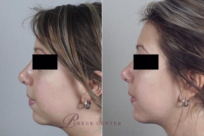 Cheek/Chin Implants Case 255 Before & After View #2 | Paramus, New Jersey | Parker Center for Plastic Surgery
