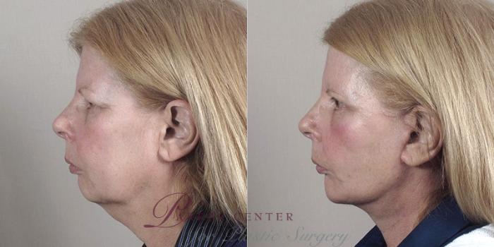 Cheek/Chin Implants Case 38 Before & After View #2 | Paramus, NJ | Parker Center for Plastic Surgery