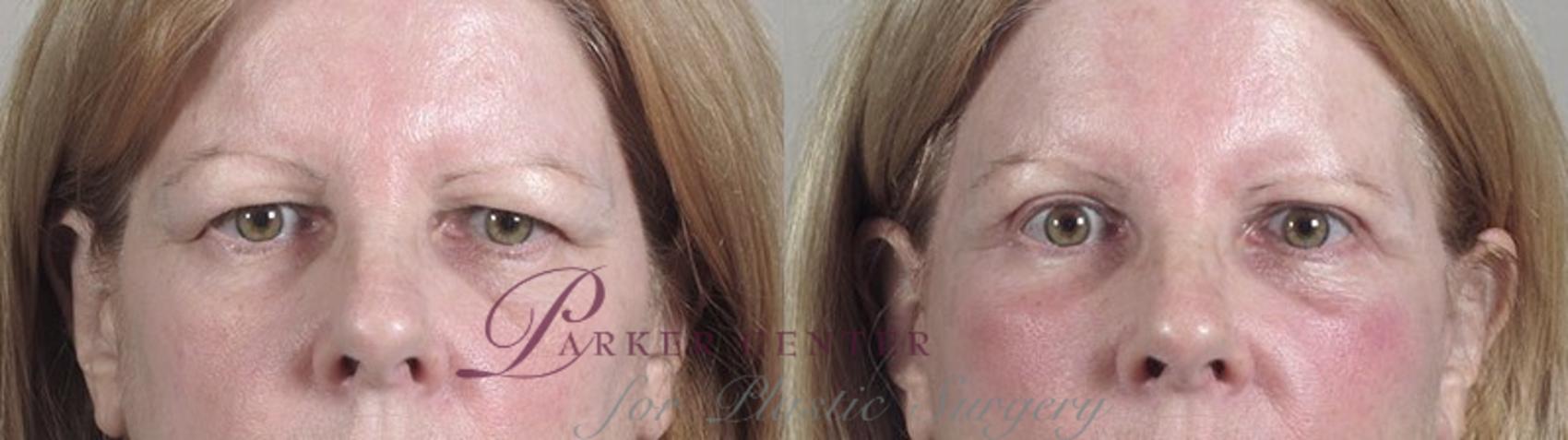 Cheek/Chin Implants Case 38 Before & After View #3 | Paramus, NJ | Parker Center for Plastic Surgery