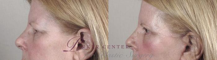 Cheek/Chin Implants Case 38 Before & After View #4 | Paramus, NJ | Parker Center for Plastic Surgery