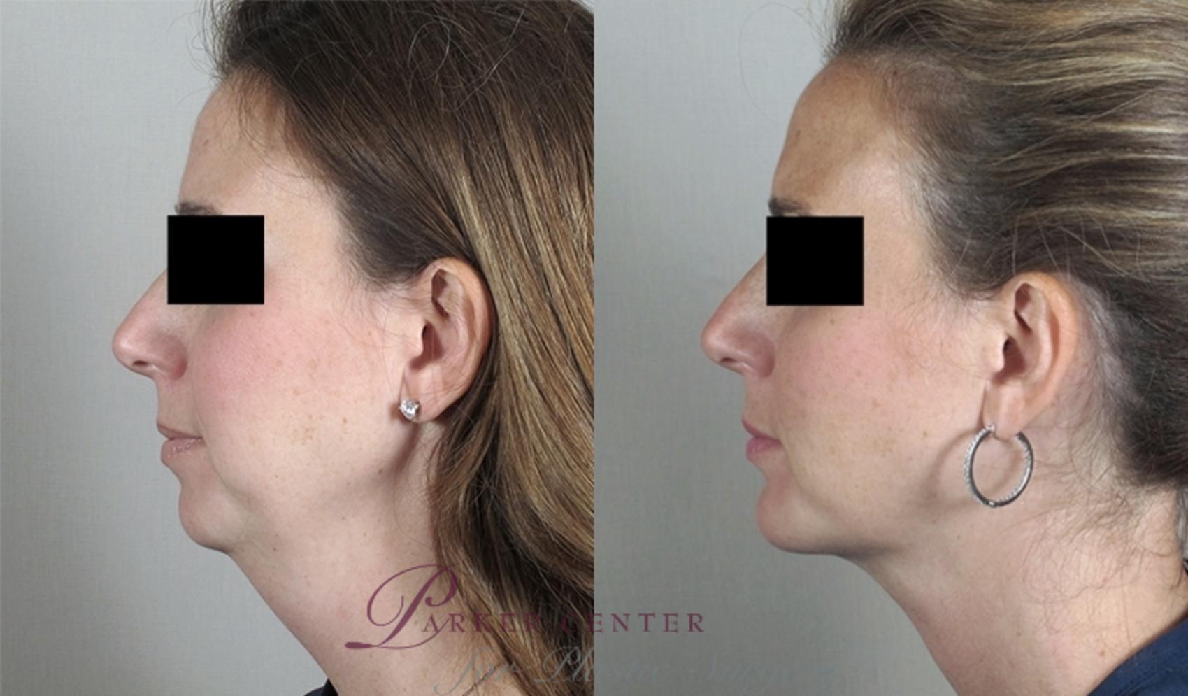 Cheek/Chin Implants Case 890 Before & After View #4 | Paramus, NJ | Parker Center for Plastic Surgery
