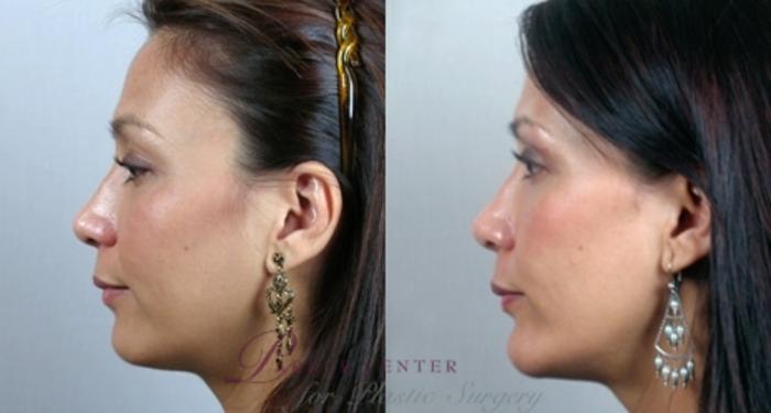 Cheek/Chin Implants Case 891 Before & After View #4 | Paramus, NJ | Parker Center for Plastic Surgery
