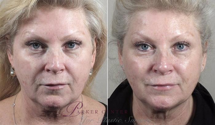 Chemical Peels Case 329 Before & After View #1 | Paramus, New Jersey | Parker Center for Plastic Surgery