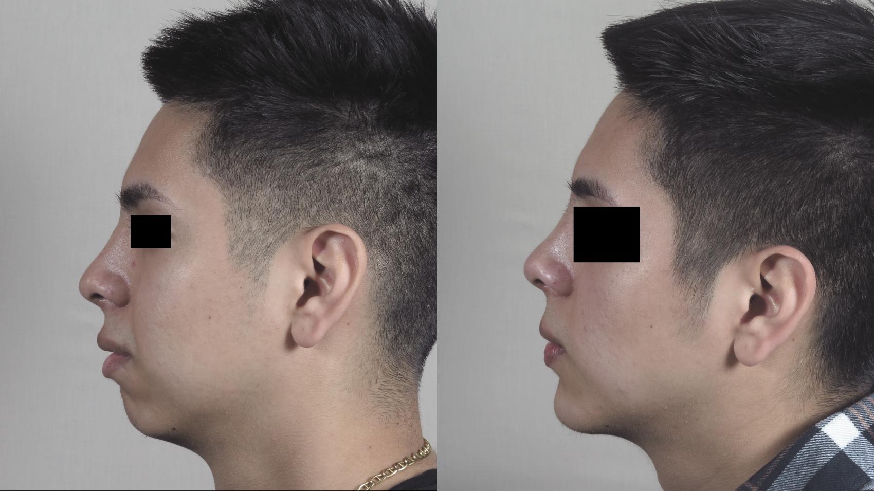 Chin Implant Case 1097 Before & After Right Side | Paramus, New Jersey | Parker Center for Plastic Surgery