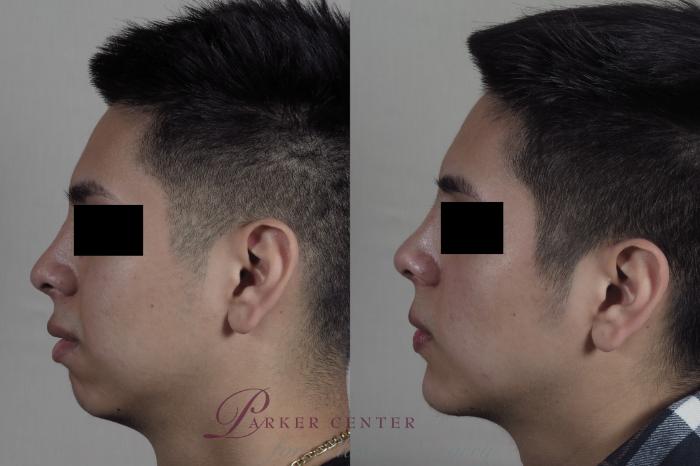 Chin Implant Case 1097 Before & After Right Side | Paramus, NJ | Parker Center for Plastic Surgery