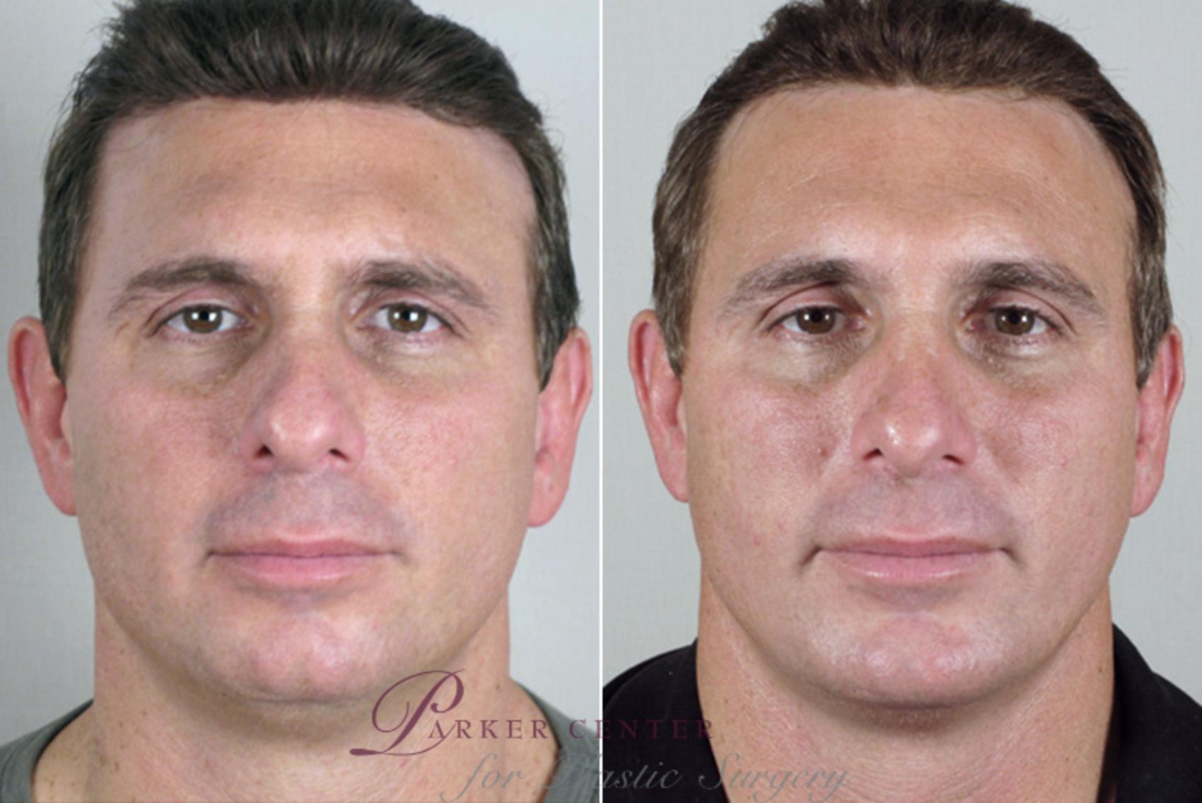 Chin Implant Case 116 Before & After View #1 | Paramus, NJ | Parker Center for Plastic Surgery