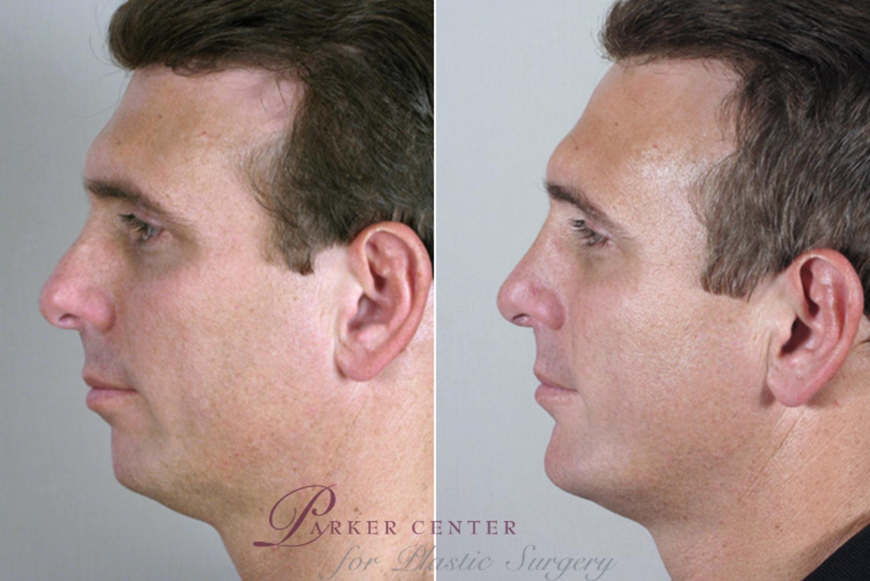 Chin Implant Case 116 Before & After View #2 | Paramus, NJ | Parker Center for Plastic Surgery