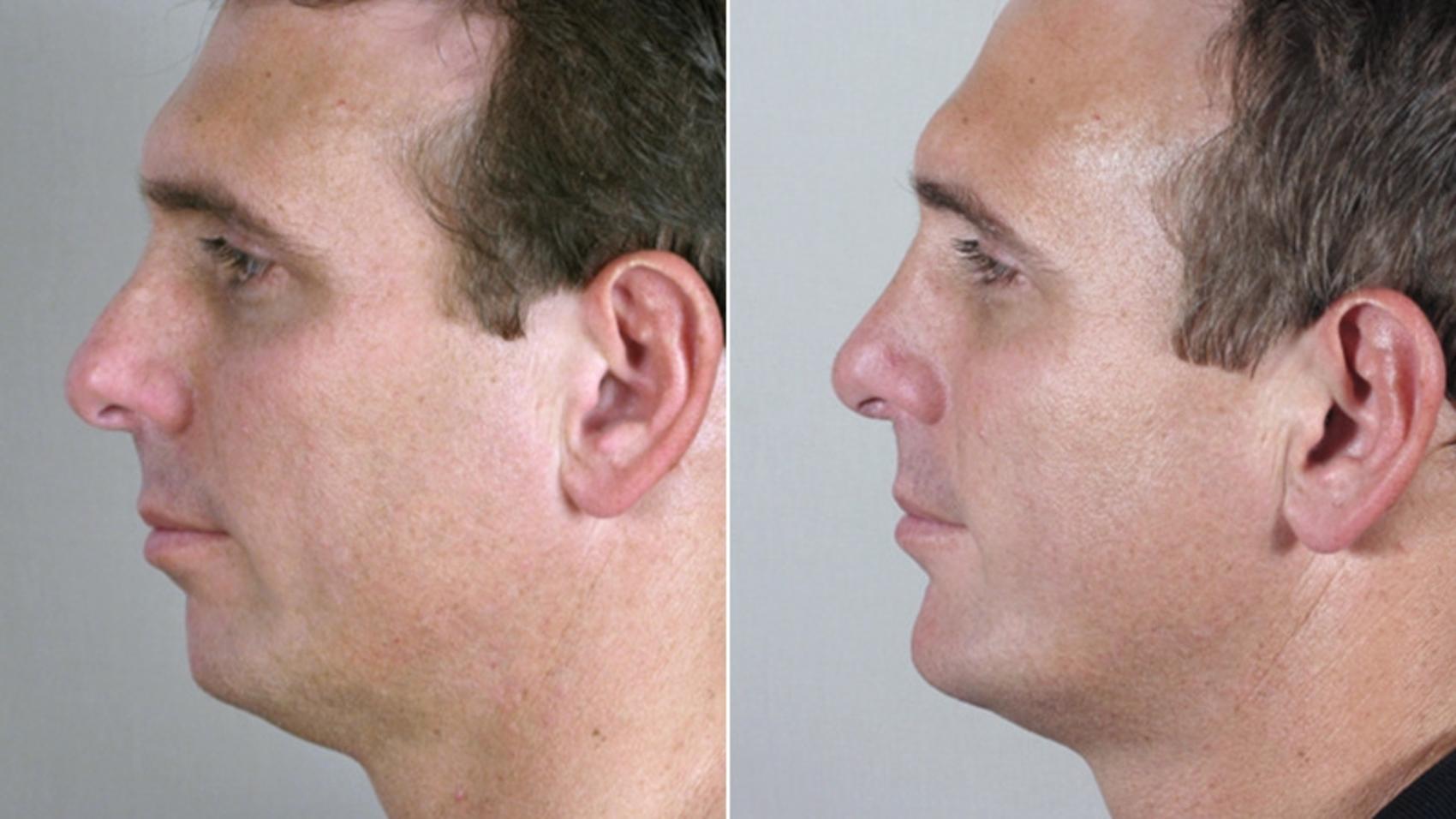 Chin Implant Case 116 Before & After View #2 | Paramus, NJ | Parker Center for Plastic Surgery