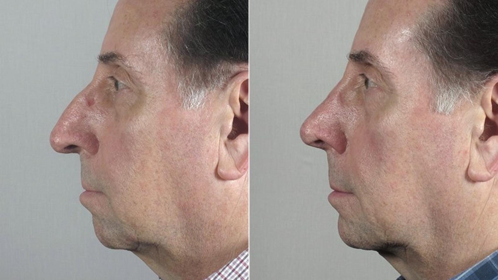 Rhinoplasty Case 184 Before & After View #1 | Paramus, NJ | Parker Center for Plastic Surgery