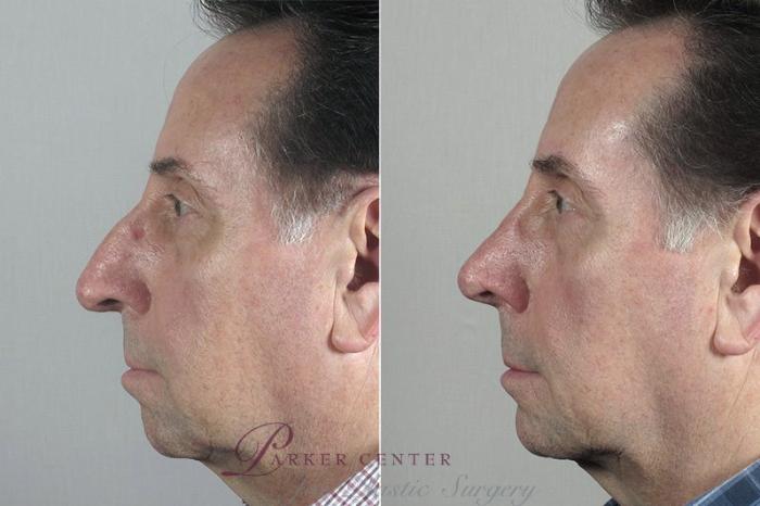 Chin Implant Case 184 Before & After View #1 | Paramus, NJ | Parker Center for Plastic Surgery