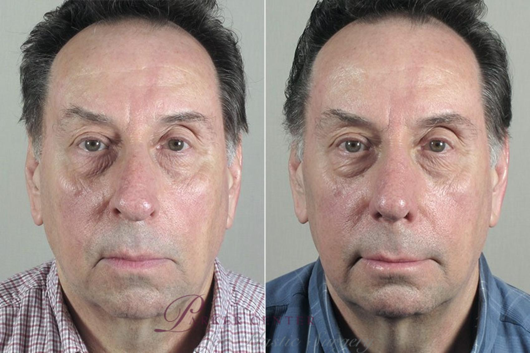 Chin Implant Case 184 Before & After View #2 | Paramus, NJ | Parker Center for Plastic Surgery