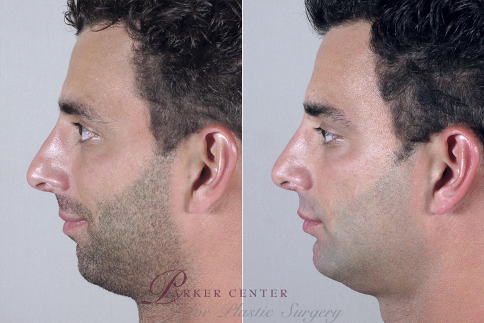 Chin Implant Case 252 Before & After View #2 | Paramus, NJ | Parker Center for Plastic Surgery
