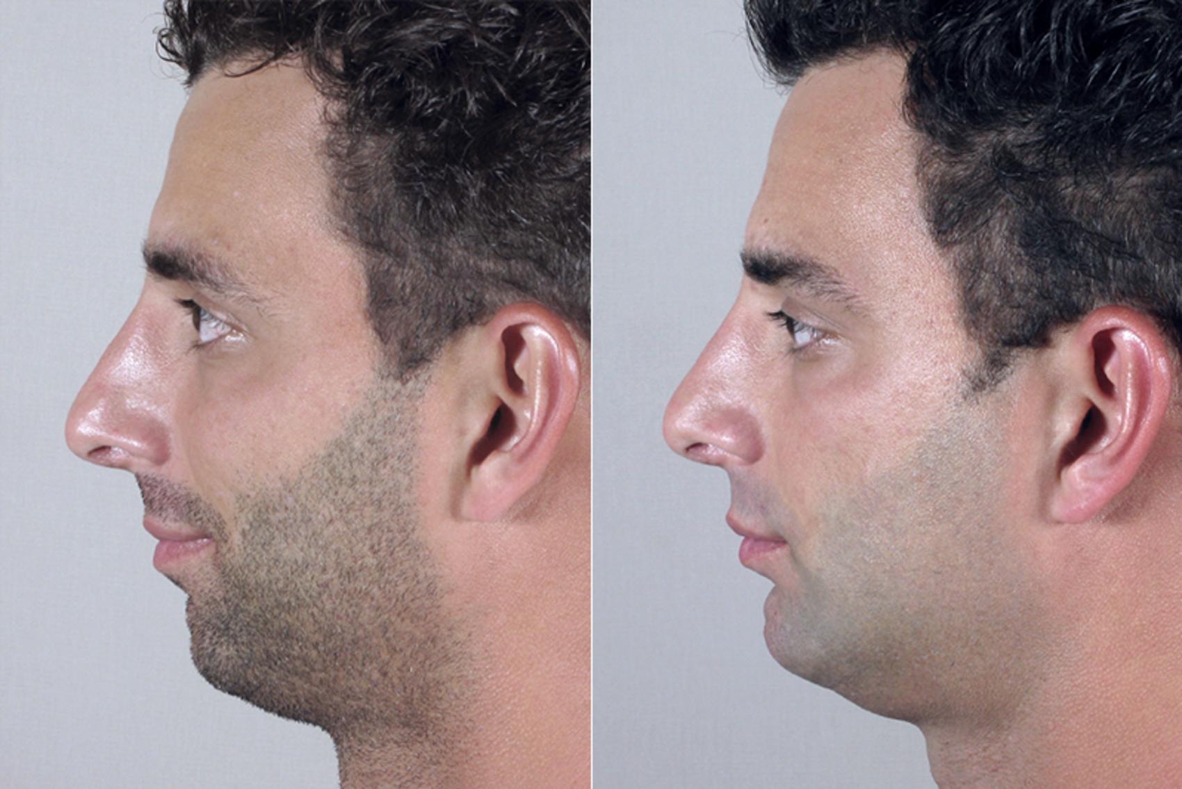 Chin Implant Case 252 Before & After View #2 | Paramus, NJ | Parker Center for Plastic Surgery