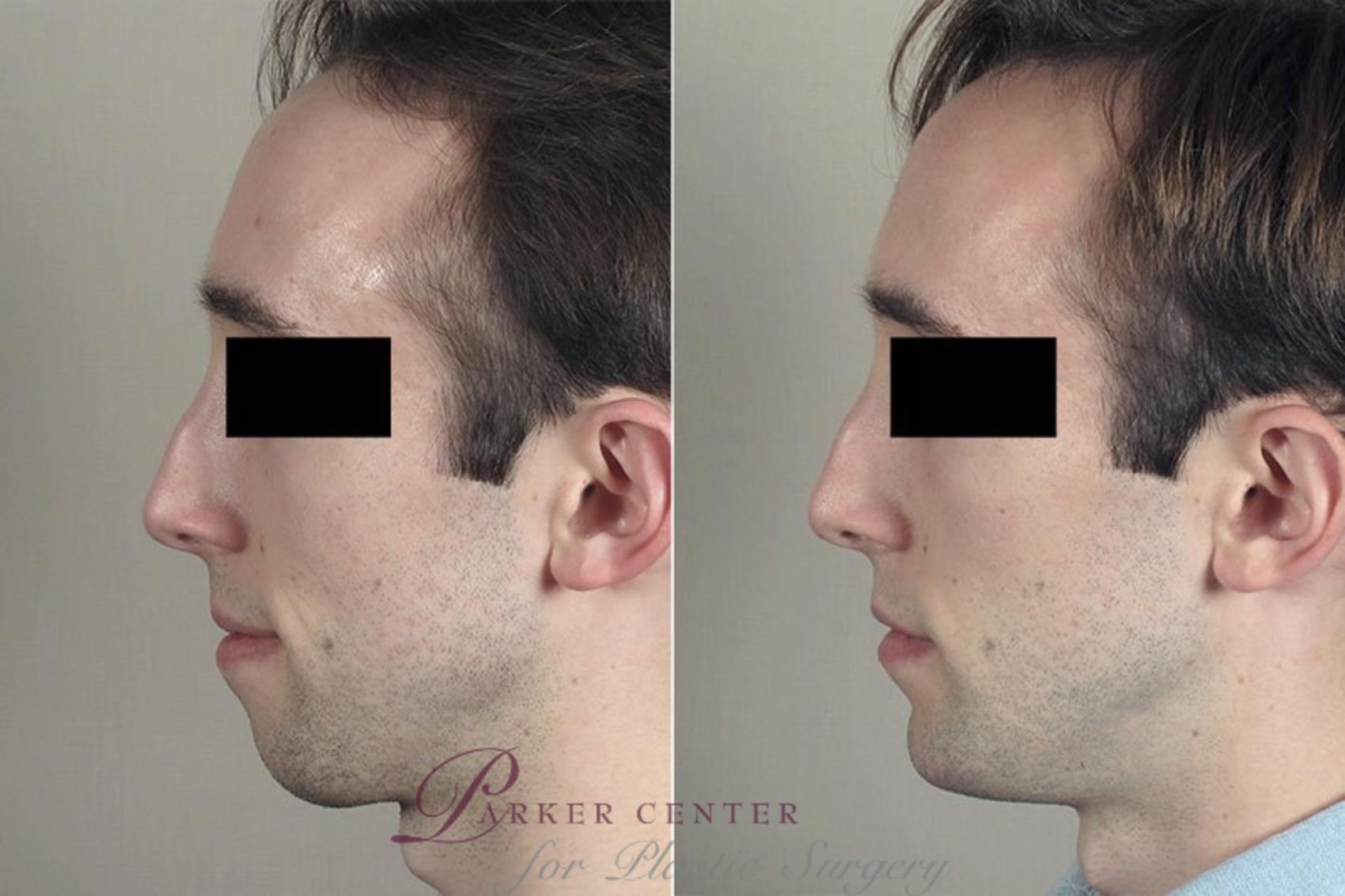 Chin Implant Case 256 Before & After View #2 | Paramus, NJ | Parker Center for Plastic Surgery
