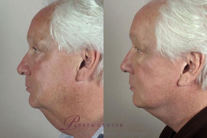 Chin Implant Case 32 Before & After View #2 | Paramus, NJ | Parker Center for Plastic Surgery